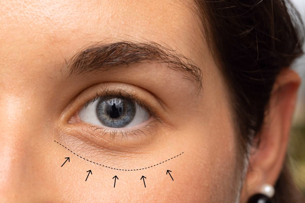 Are you eligible for eyelid surgery?