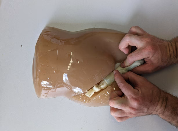 How to reduce an acute inguinal hernia?